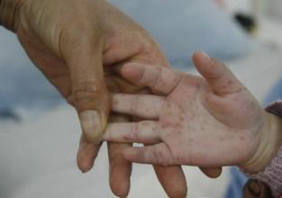 北京迎手足口病高发季已报告疫情20起涉及病例61人